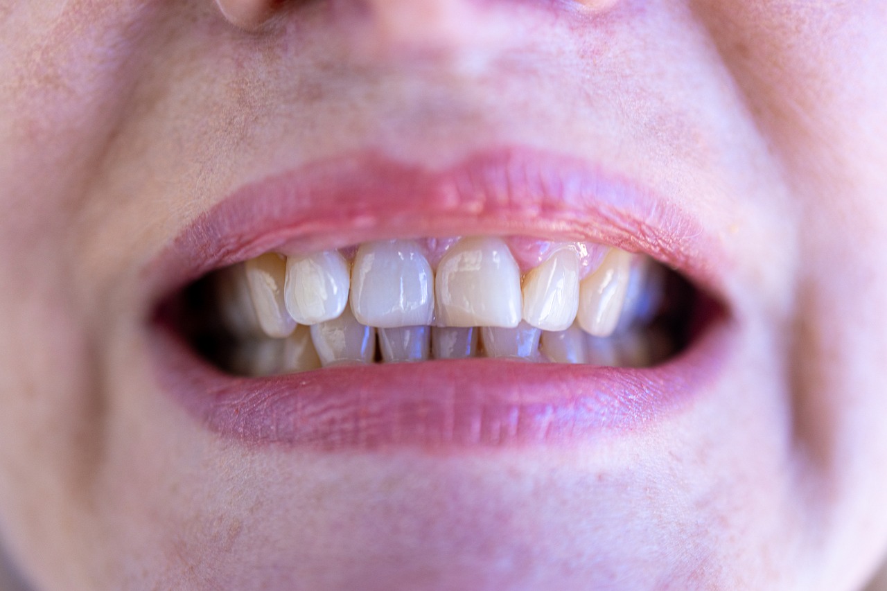 Wenn Kinder nur durch den Mund atmen... KELLE